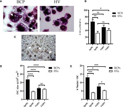 Spontaneous Osteoclastogenesis, a risk factor for bone metastasis in advanced luminal A-type breast cancer patients